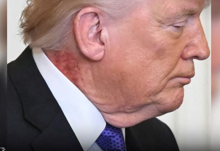 البيت الابيض يكشف طبيعة اصابة ترامب في الرقبة